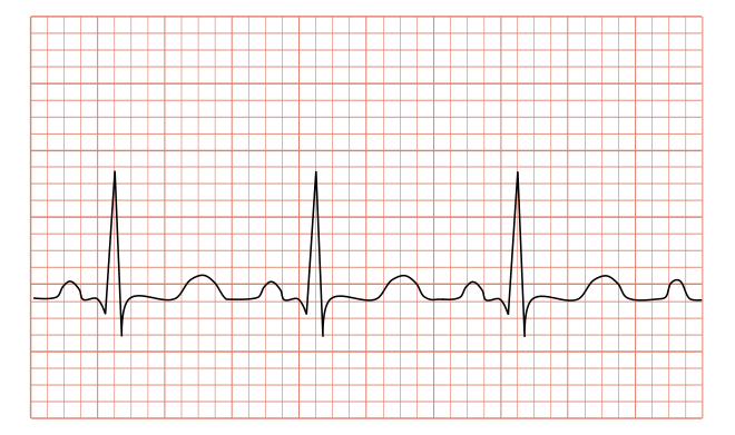 File:Tachycardia ECG paper.svg