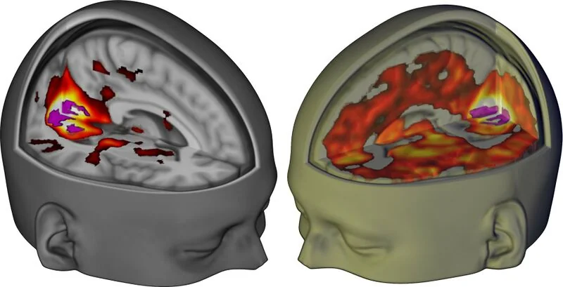 File:Lsd brain scan.jpg