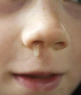 File:Runny nose.jpg
